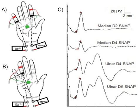 carpal tunnel test results